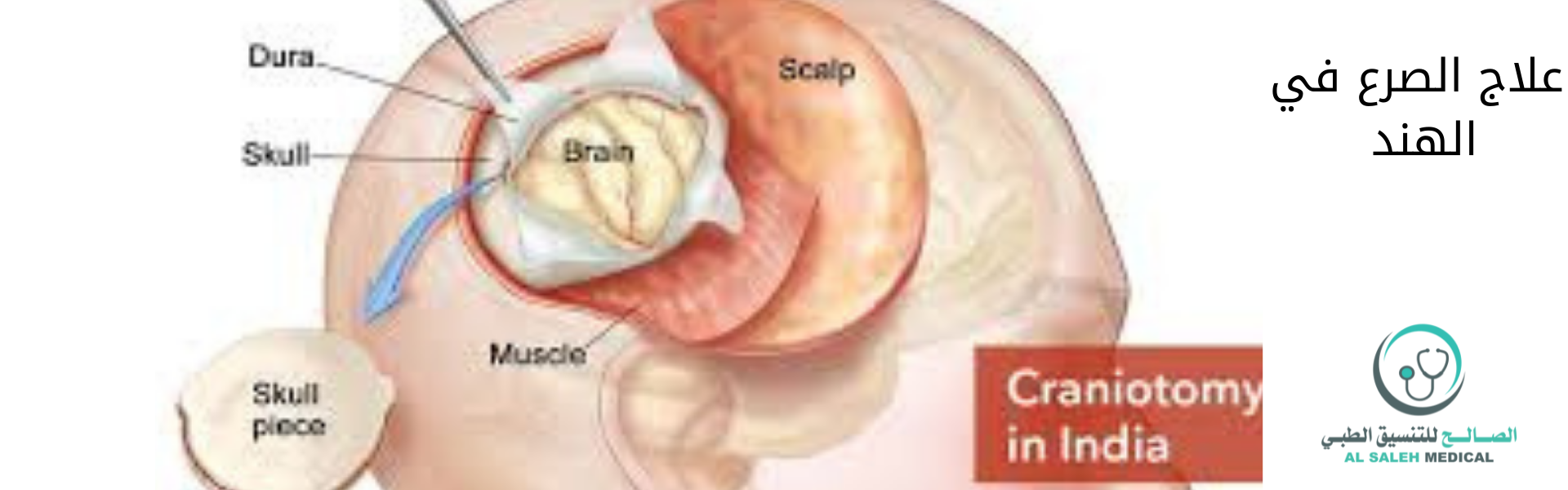  تكلفة علاج الصرع في الهند | التكلفة والمستشفيات ذات الكفاءة العالية